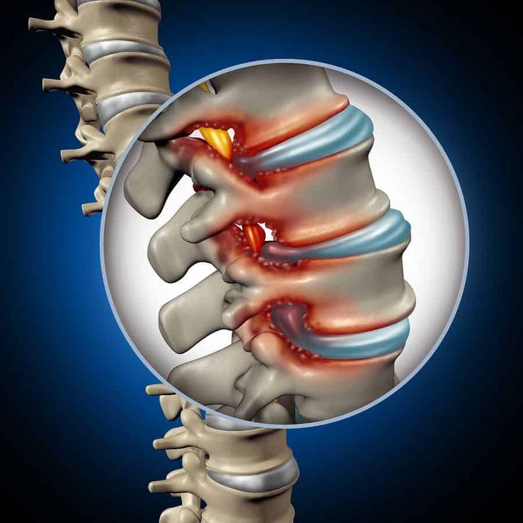 Vitruvian Wellness Center | How Spinal Decompression Helps Relieve Herniated Disc Pain